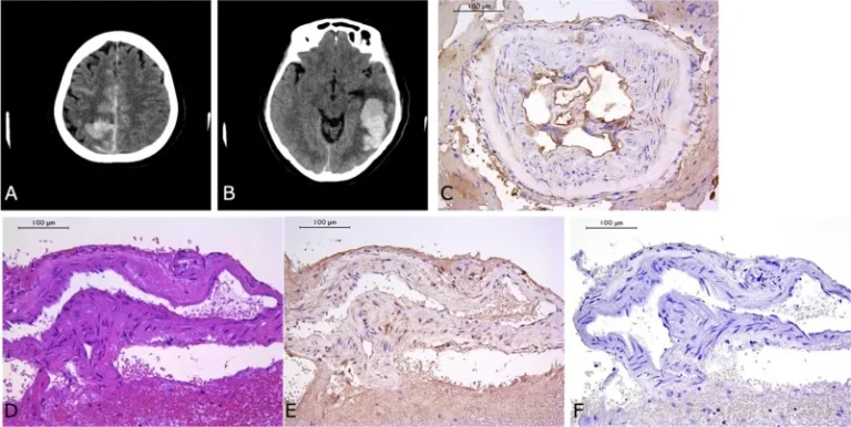 Η Spike-πρωτεΐνη στον εγκέφαλο στο 43,8 % των εμβολιασμένων με εγκεφαλικό.