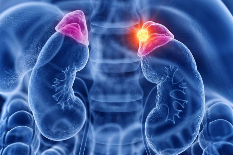 Σύνδρομο Επινεφριδιακής Εξουθένωσης (Adrenal Burnout Syndrome)