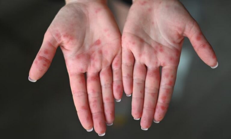 Συναγερμός στο Τενεσί: Μεταδοτική ασθένεια εξαπλώνεται ραγδαία σε σχολεία – Επώδυνα συμπτώματα σε μικρά παιδιά