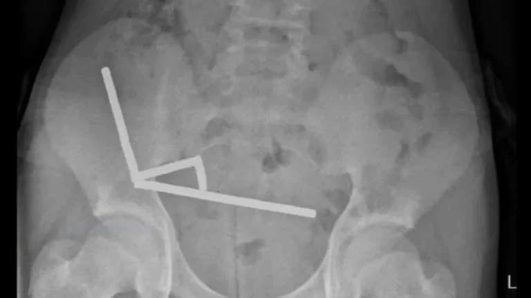 Δεκάδες μαγνήτες από τα έντερα 13χρονου αφαίρεσαν γιατροί στη Νέα Ζηλανδία