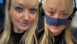 Εφιάλτης για Βρετανίδα που πήγε στην Τουρκία για νέα δόντια: «Μόλυνση μου “έφαγε” τη μύτη»