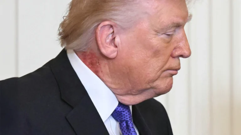 Εξάνθημα στον λαιμό του Τραμπ προκαλεί νέα ερωτήματα για την υγεία του