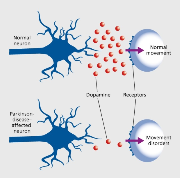 parkinson
